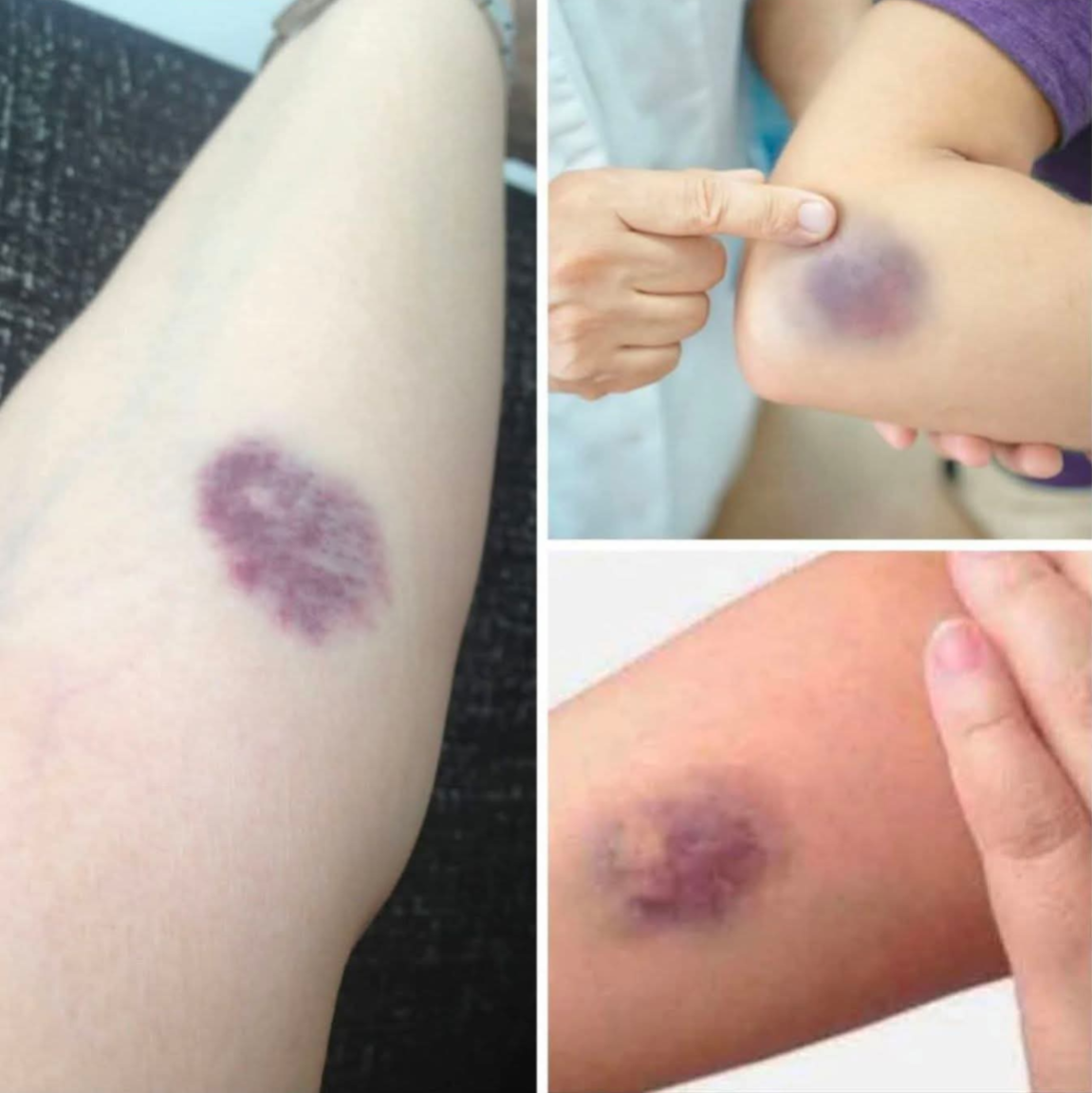 ⚠️ BE CAREFUL, if you get these bruises on your body, it means you have Ca…see more